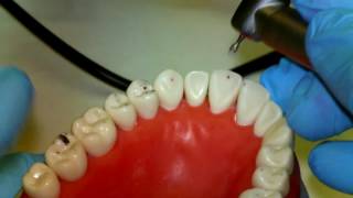 Occlusal Equilibration [upl. by Singer]