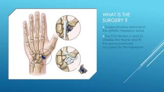 Osteoarthritis of carpometacarpal Thumb joint [upl. by Olav]