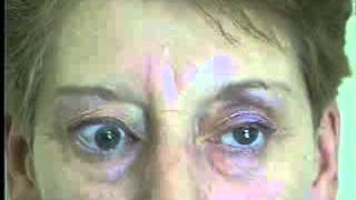 Thyroid Eye Disease Examination [upl. by Aihsa127]