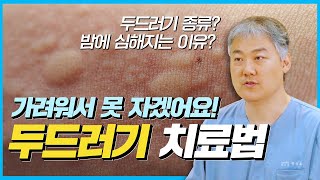 두드러기 종류부터 대처법 치료법 총정리 [upl. by Eivets]