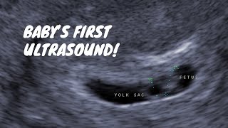 Babys First Ultrasound 6 Weeks Pregnant [upl. by Eldwon]