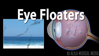 Eye Floaters and Flashes Animation [upl. by Adnohsel383]