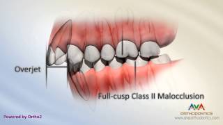 Malocclusion  Class II Div I [upl. by Ardnal]