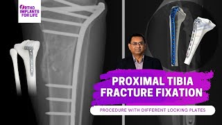 Proximal Tibia Locking Plates Fixation Procedure [upl. by Maloy499]