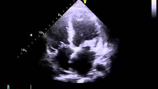 Echocardiography to Assess MitralValve Leaflets  NEJM [upl. by Firmin]