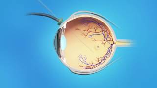 Macular Hole Vitrectomy Surgery [upl. by Hildegard]