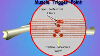 03What is a Muscle Trigger Point [upl. by Sharleen]