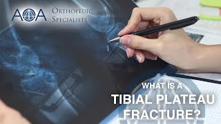 AOA Orthopedic Specialists  Tibial Plateau Fracture [upl. by Meerak]