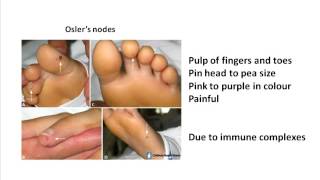 Heberdens nodes and Bouchards nodes Osteoarthritis [upl. by Ahsram]