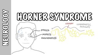 Horner Syndrome  anatomy causes pathophysiology investigation [upl. by Akzseinga]