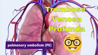 Trombose Venosa Profunda TVP e Embolia Pulmonar EP [upl. by Kere470]