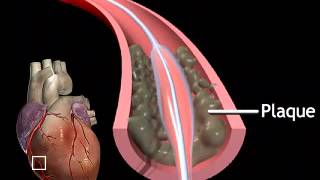 Coronary Angiography  NEJM [upl. by Anol]