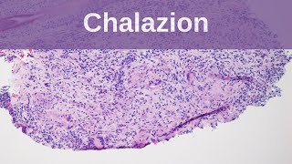 Chalazion  Pathology mini tutorials [upl. by Iaht]