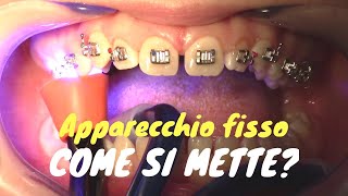 Come si mette lapparecchio fisso [upl. by Astrid]