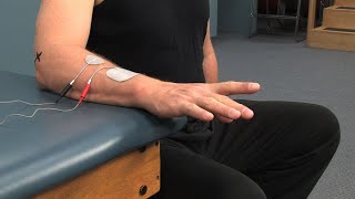 Electrode Placement for Finger Extension Muscle Stimulation [upl. by Muhcon]