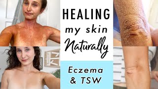 How I CURED Eczema amp Topical Steroid Withdrawal NATURALLY  My Skin Healing Journey [upl. by Eiramllij]