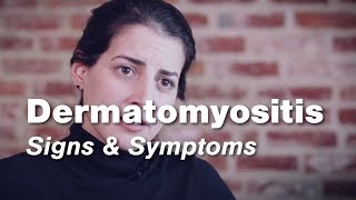 Dermatomyositis – Signs amp Symptoms  Johns Hopkins [upl. by Halivah645]