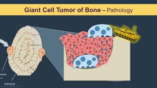 Giant cell tumor of Bone Osteoclastoma  Pathology [upl. by Warton]