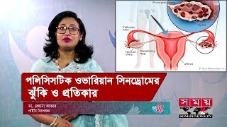 OVARIAN CYSTS What Causes Ovarian Cysts [upl. by Meijer]