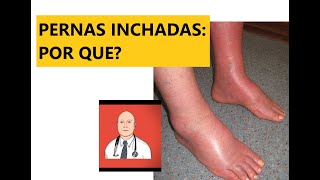 As 9 causas principais de pernas inchadas com sinais de alerta para ver o médico [upl. by Tannie]