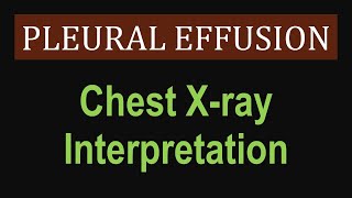 Pleural Effusion  Chest Xray Interpretation [upl. by Lange]