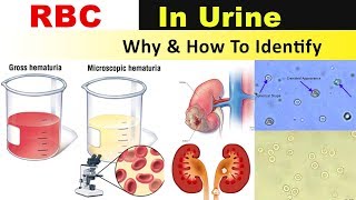 Urine Analysis2  Microscopic Examination [upl. by Asirahc]