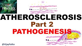 ATHEROSCLEROSIS  Part 2 Pathogenesis [upl. by Niatsirhc]