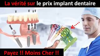 Prix implant dentaire  partie 1 [upl. by Indira]