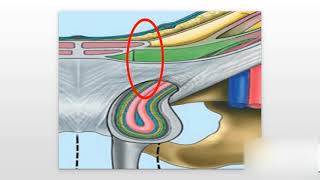 Inguinal Hernias Explained [upl. by Laband]