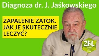 dr Jerzy Jaśkowski  Leczenie zapalenia zatok [upl. by Clute76]