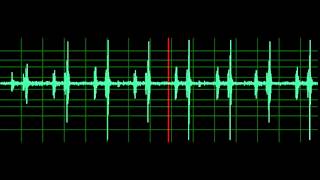 Pulmonary Associated Heart Sounds PAH Split S2 [upl. by Sirromed842]