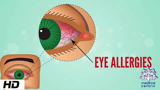 Ask The Expert  Dr Gabriel Sosne  Pink Eye and Viral Eye Infections [upl. by Elokin]