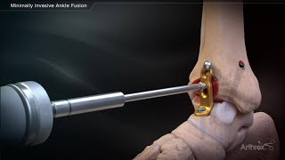 Antegrade Femoral Nail System Surgical Technique [upl. by Leonardi]