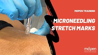 STRETCH MARKS MICRONEEDLING PROCEDURE  MDPEN TRAINING [upl. by Asseneg70]