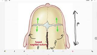 Craniosynostosis [upl. by Sibylla]