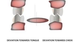 Introduction to equilibration Occlusal interferences [upl. by Abdul]