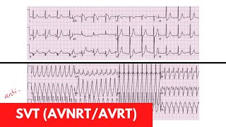 SVT AVRT AVNRT  For DO MD NP PA Part 3 [upl. by Aicillyhp296]