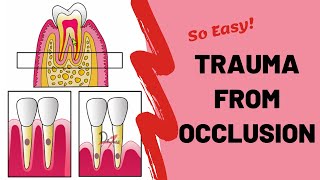 Trauma From Occlusion TFO  PERIODONTOLOGY [upl. by Daryle79]