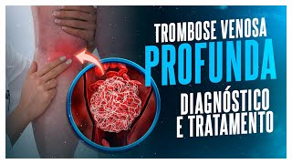 TROMBOSE VENOSA PROFUNDA  DIAGNÓSTICO E TRATAMENTO [upl. by Loyce719]