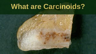 Carcinoid Tumor Causes Signs and Symptoms Diagnosis and Treatment [upl. by Spanjian]