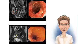 ENFERMEDAD DE CROHN [upl. by Sina]