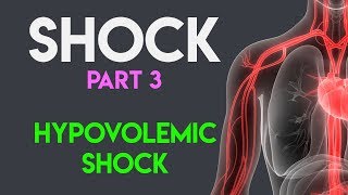 Hypovolemic Shock  Shock Part 3 [upl. by Hinda122]