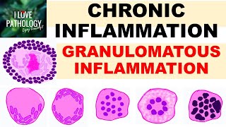 INFLAMMATION Part 9 Chronic Inflammation  GRANULOMATOUS INFLAMMATION [upl. by Enra]