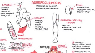 Atherosclerosis  Pathophysiology [upl. by Lap]