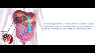 PLTW  PBS  Unit 4 Heart Disease Review [upl. by Evad]