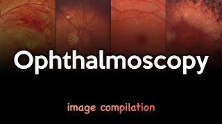 Ophthalmoscopy [upl. by Hennahane]