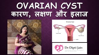 What are ovarian cysts [upl. by Justicz]