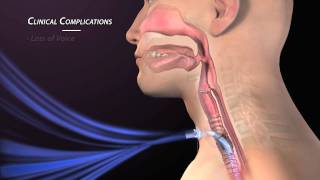 HVRSS 8 Tracheostomy Suction at Home [upl. by Troyes736]