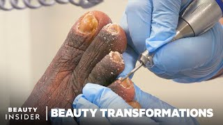 How Medical Pedicures Transform Feet [upl. by Ynor]