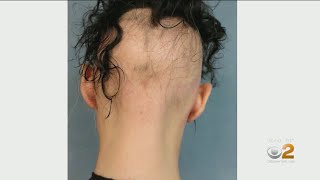 Eczema Treatment Helping Some Alopecia Sufferers Regrpw Hair [upl. by Dlorad286]